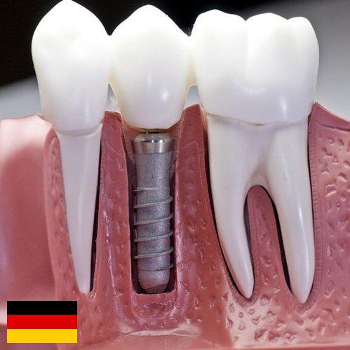 Зубные импланты из Германии